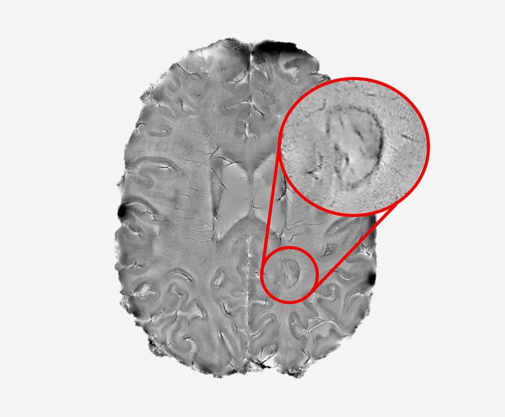 MRI of rimmed lesion