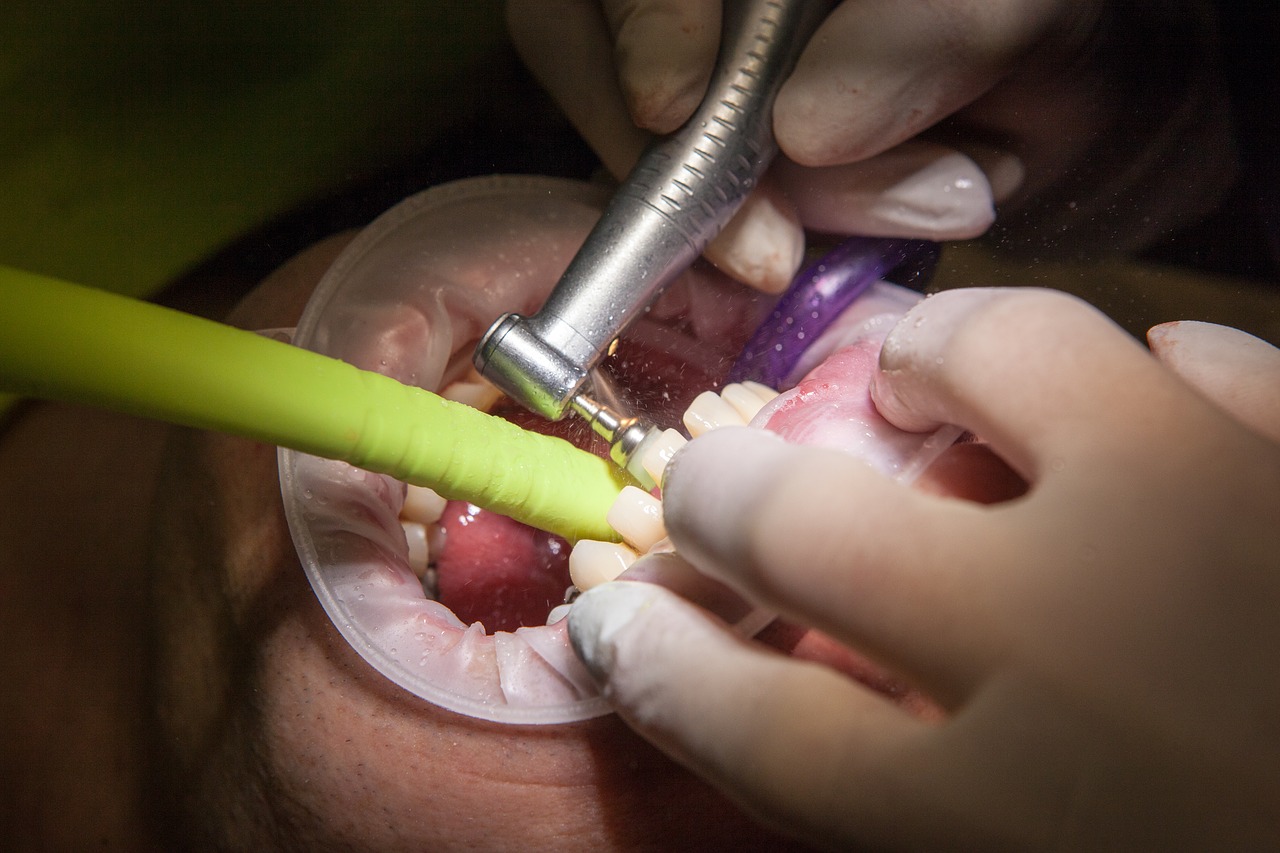 MS and Dental Fillings – A New FDA Recommendation